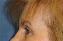 Eyelid Surgery After Photo by George John Alexander, MD, FACS; ,  - Case 31285