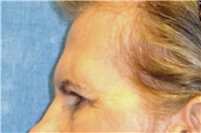 Eyelid Surgery Before Photo by George John Alexander, MD, FACS; ,  - Case 31285