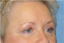 Eyelid Surgery After Photo by George John Alexander, MD, FACS; ,  - Case 31287