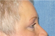 Eyelid Surgery After Photo by George John Alexander, MD, FACS; ,  - Case 31287