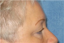 Eyelid Surgery Before Photo by George John Alexander, MD, FACS; ,  - Case 31287