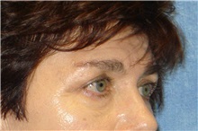 Brow Lift Before Photo by George John Alexander, MD, FACS; ,  - Case 31288
