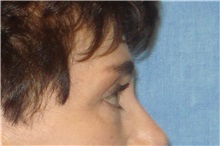 Brow Lift After Photo by George John Alexander, MD, FACS; ,  - Case 31288