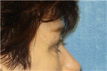 Brow Lift Before Photo by George John Alexander, MD, FACS; ,  - Case 31288