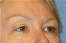 Brow Lift Before Photo by George John Alexander, MD, FACS; ,  - Case 31289