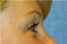 Brow Lift After Photo by George John Alexander, MD, FACS; ,  - Case 31289