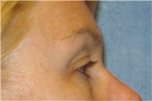 Brow Lift Before Photo by George John Alexander, MD, FACS; ,  - Case 31289