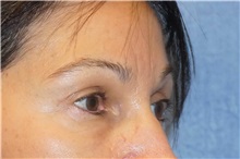 Brow Lift After Photo by George John Alexander, MD, FACS; ,  - Case 31291