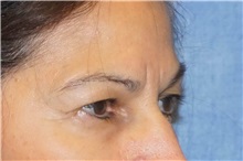 Brow Lift Before Photo by George John Alexander, MD, FACS; ,  - Case 31291