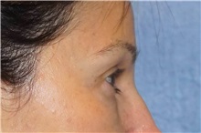 Brow Lift After Photo by George John Alexander, MD, FACS; ,  - Case 31291
