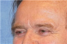 Eyelid Surgery After Photo by George John Alexander, MD, FACS; Las Vegas, NV - Case 31292