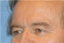 Eyelid Surgery Before Photo by George John Alexander, MD, FACS; Las Vegas, NV - Case 31292