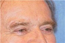 Eyelid Surgery After Photo by George John Alexander, MD, FACS; Las Vegas, NV - Case 31292