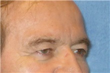 Eyelid Surgery Before Photo by George John Alexander, MD, FACS; Las Vegas, NV - Case 31292