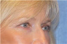 Eyelid Surgery After Photo by George John Alexander, MD, FACS; ,  - Case 31293