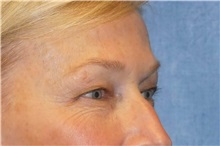 Eyelid Surgery Before Photo by George John Alexander, MD, FACS; ,  - Case 31293