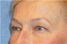 Eyelid Surgery Before Photo by George John Alexander, MD, FACS; ,  - Case 31293