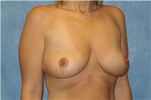 Breast Lift After Photo by George John Alexander, MD, FACS; ,  - Case 31294