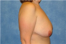 Breast Lift Before Photo by George John Alexander, MD, FACS; ,  - Case 31294
