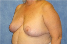 Breast Reduction After Photo by George John Alexander, MD, FACS; ,  - Case 31295