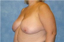 Breast Reduction Before Photo by George John Alexander, MD, FACS; ,  - Case 31295