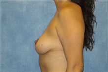 Breast Lift After Photo by George John Alexander, MD, FACS; ,  - Case 31297
