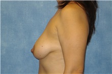 Breast Lift Before Photo by George John Alexander, MD, FACS; ,  - Case 31297