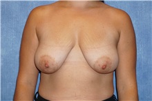 Breast Lift Before Photo by George John Alexander, MD, FACS; ,  - Case 31298