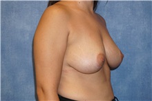 Breast Lift After Photo by George John Alexander, MD, FACS; ,  - Case 31298