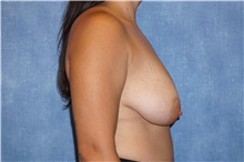 Breast Lift Before Photo by George John Alexander, MD, FACS; ,  - Case 31298