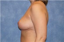Breast Lift After Photo by George John Alexander, MD, FACS; ,  - Case 31299