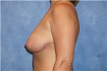 Breast Lift Before Photo by George John Alexander, MD, FACS; ,  - Case 31299
