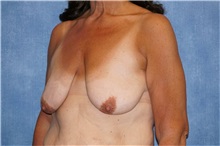 Breast Lift Before Photo by George John Alexander, MD, FACS; ,  - Case 31300