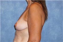 Breast Lift After Photo by George John Alexander, MD, FACS; ,  - Case 31300