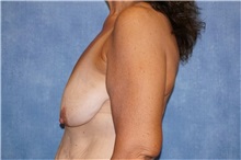 Breast Lift Before Photo by George John Alexander, MD, FACS; ,  - Case 31300