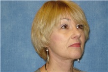 Facelift After Photo by George John Alexander, MD, FACS; ,  - Case 31301