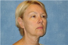 Facelift Before Photo by George John Alexander, MD, FACS; ,  - Case 31301
