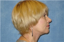 Facelift After Photo by George John Alexander, MD, FACS; ,  - Case 31301