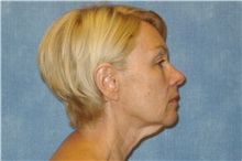 Facelift Before Photo by George John Alexander, MD, FACS; ,  - Case 31301