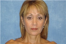 Facelift After Photo by George John Alexander, MD, FACS; ,  - Case 31302