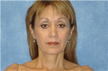 Facelift Before Photo by George John Alexander, MD, FACS; ,  - Case 31302