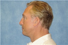 Facelift After Photo by George John Alexander, MD, FACS; ,  - Case 31303
