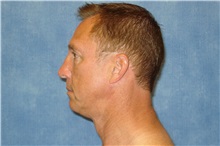 Facelift Before Photo by George John Alexander, MD, FACS; ,  - Case 31303