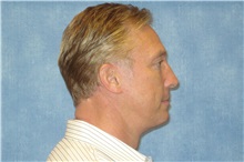 Facelift After Photo by George John Alexander, MD, FACS; ,  - Case 31303