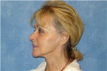 Facelift After Photo by George John Alexander, MD, FACS; ,  - Case 31304