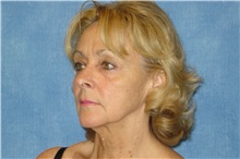 Facelift Before Photo by George John Alexander, MD, FACS; ,  - Case 31304