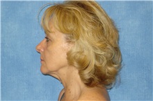 Facelift Before Photo by George John Alexander, MD, FACS; ,  - Case 31304