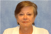 Facelift After Photo by George John Alexander, MD, FACS; ,  - Case 31306