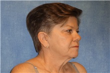 Facelift Before Photo by George John Alexander, MD, FACS; ,  - Case 31306