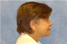 Facelift After Photo by George John Alexander, MD, FACS; ,  - Case 31306